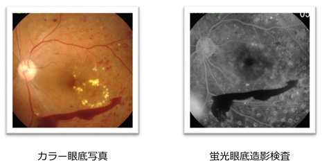 蛍光眼底造影検査