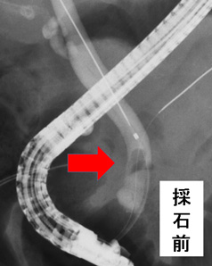 逆行性膵胆管造影　ERCP