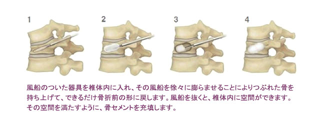 BKPの術式概要