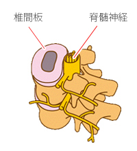 脊柱管狭窄症